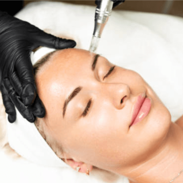 PRP Facial Microneedling 3-pack at Paige Fink Aesthetics in Orlando, FL